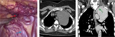 Case Report: The Second Near-Infrared Window Indocyanine Green Angiography in Giant Mediastinal Tumor Resection